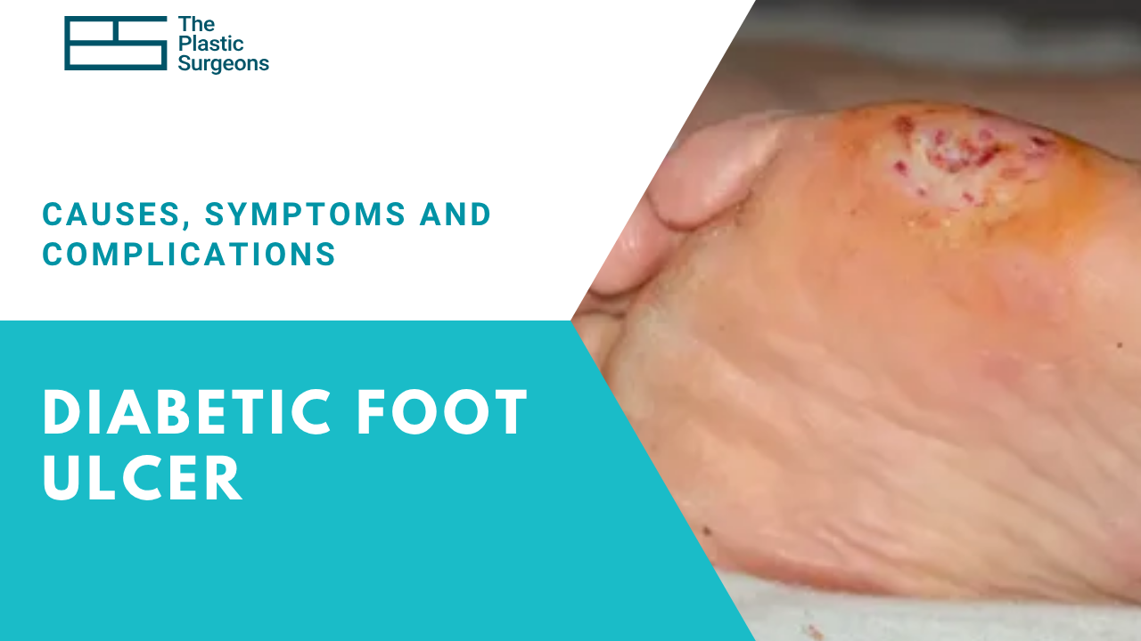 diabetic-foot-ulcer-causes-symptoms-and-complications