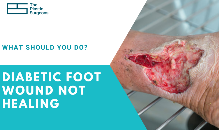 Diabetic Foot Wound Not Healing: What Should You Do?
