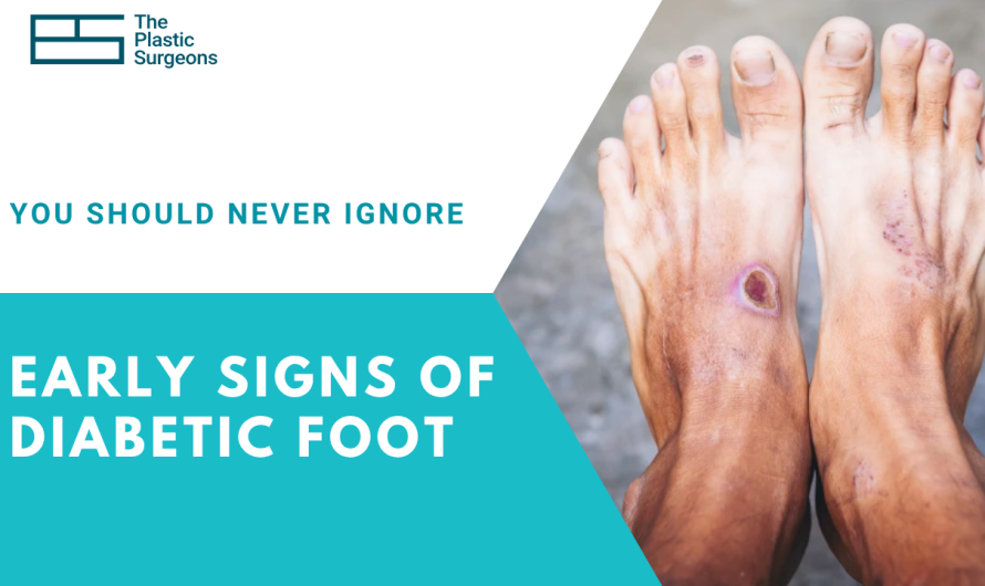 Early Signs of Diabetic Foot You Should Never Ignore