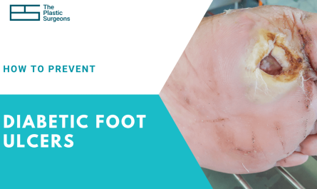 how-to-prevent-diabetic-foot-ulcers