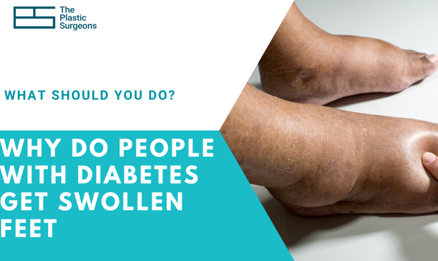 Why Do People With Diabetes Get Swollen Feet?