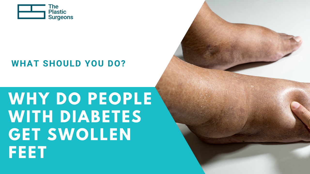 why-do-people-get-swollen-feet