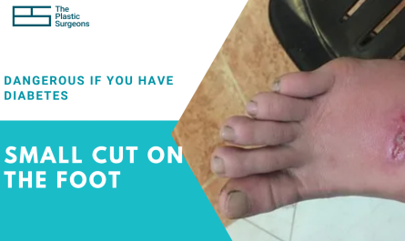can-a -small-cut-on-the-foot-become-dangerous-if-you-have-diabetes