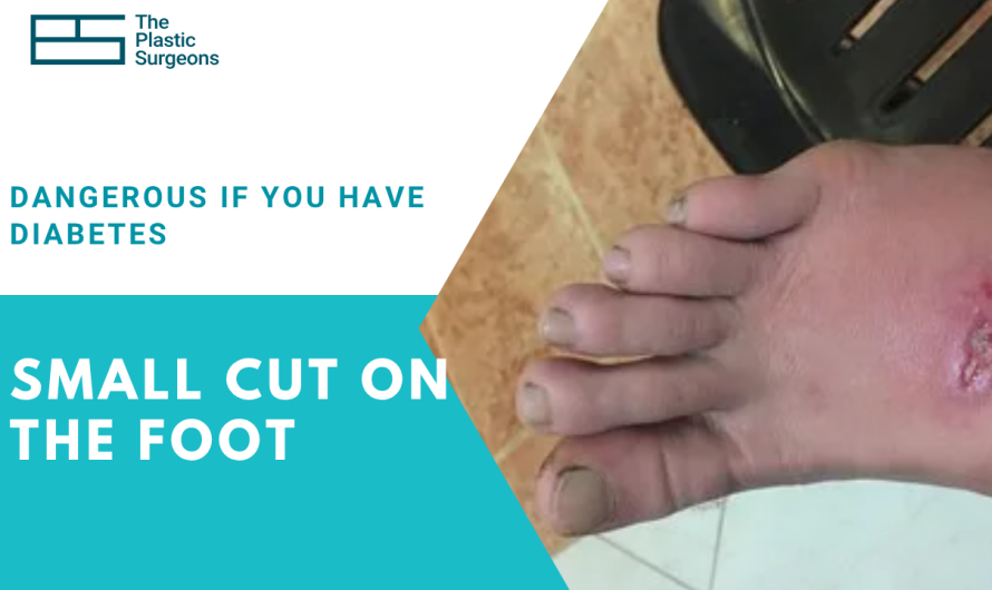 Can a Small Cut on the Foot Become Dangerous If You Have Diabetes?