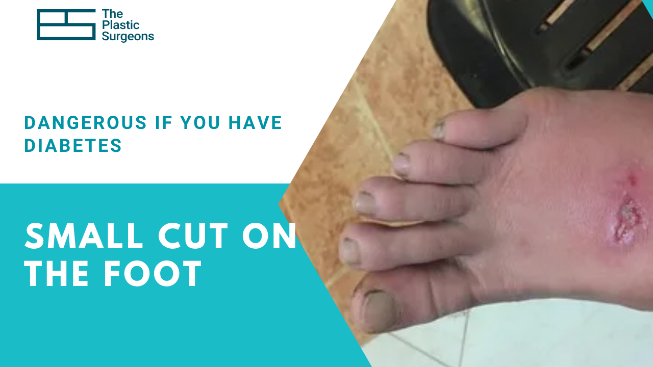 can-a -small-cut-on-the-foot-become-dangerous-if-you-have-diabetes