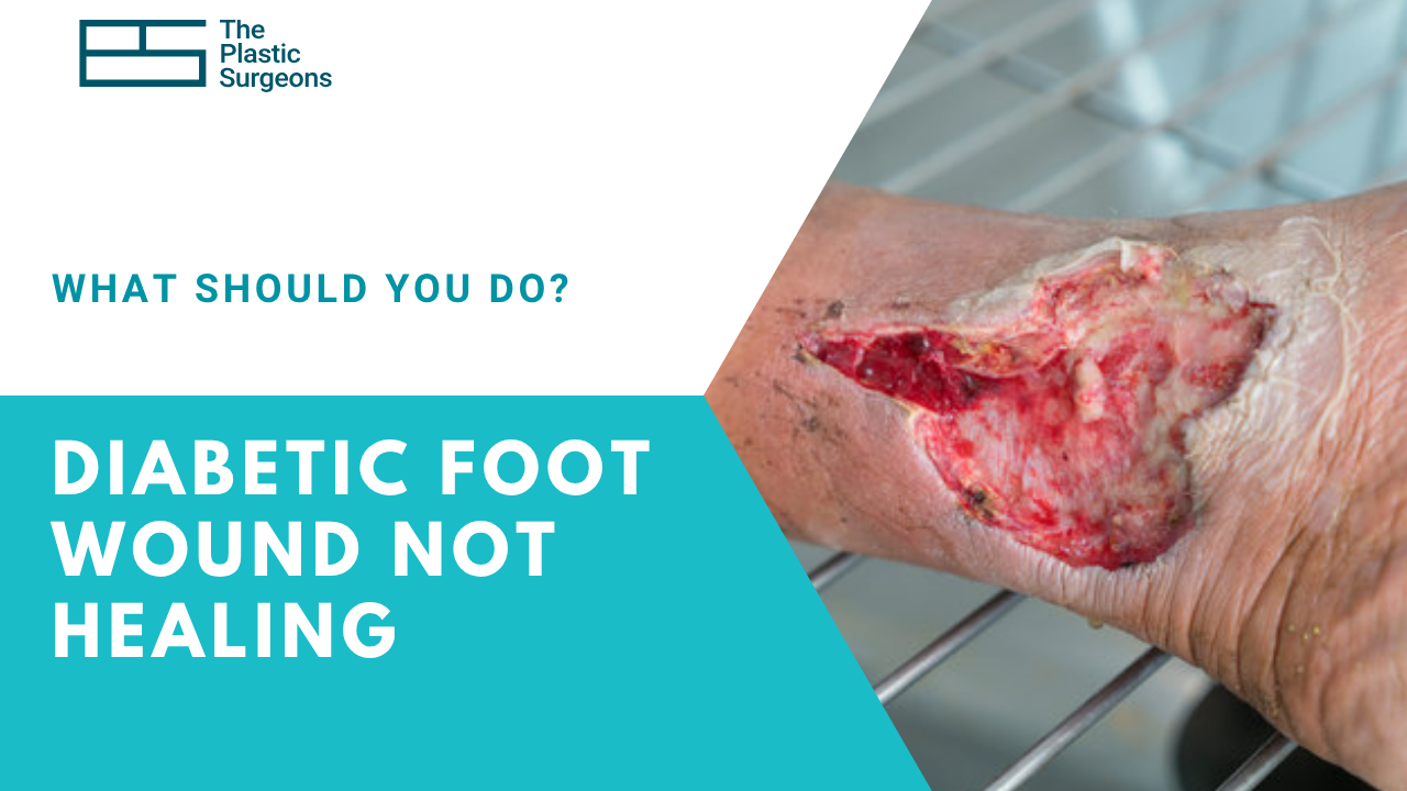 diabetic-foot-wound-not-healing-what-should-you-do