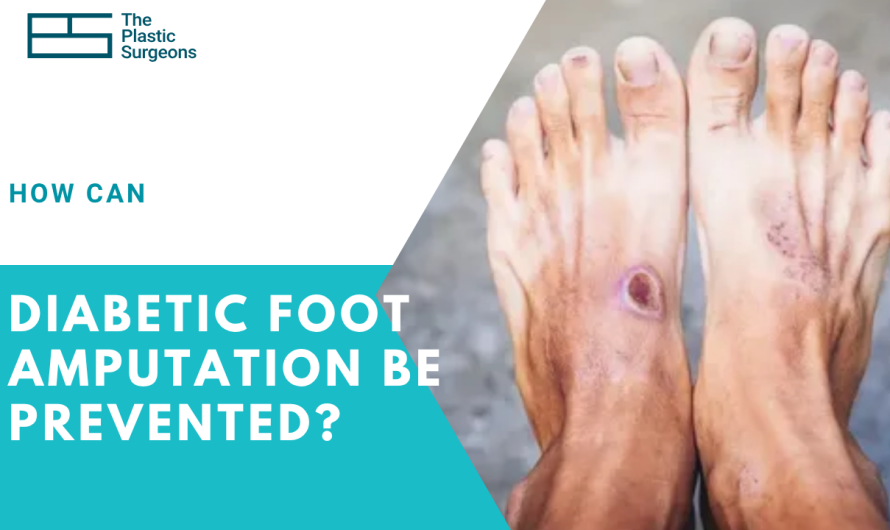 How Can Diabetic Foot Amputation Be Prevented?