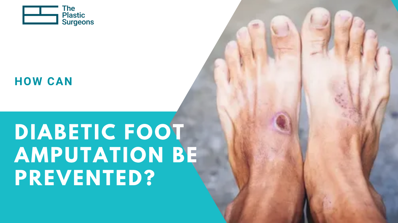 how-can-diabetic-foot-amputation-be-prevented