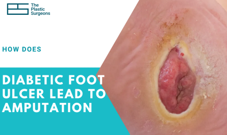 how-does-a-diabetic-foot-ulcer-lead-to-amputation