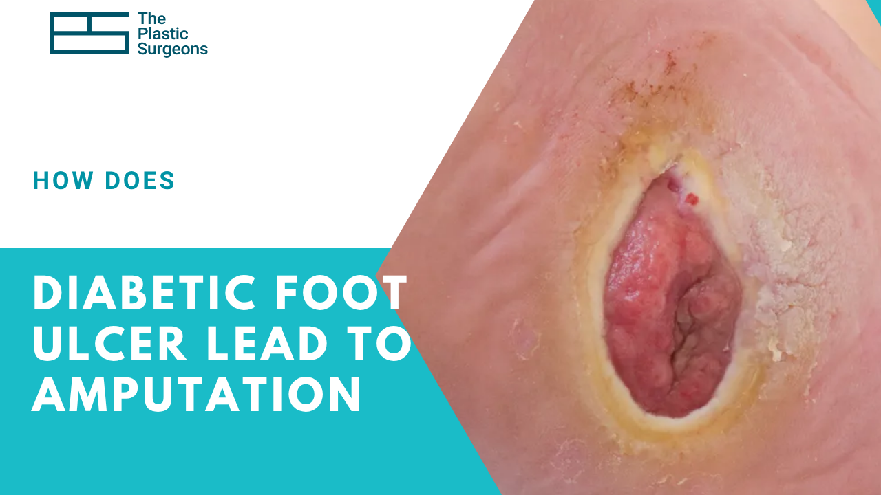 how-does-a-diabetic-foot-ulcer-lead-to-amputation