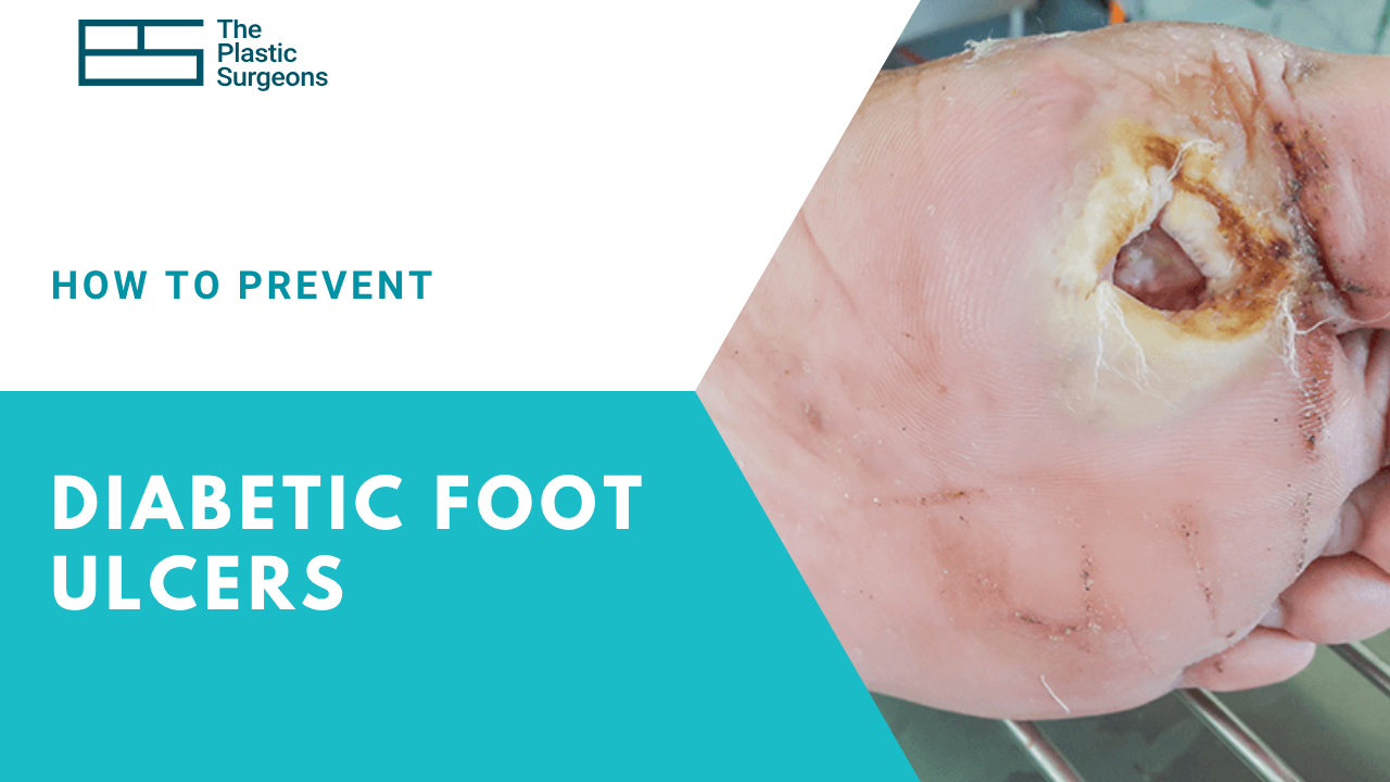how-to-prevent-diabetic-foot-ulcer