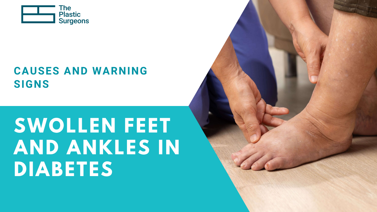 swollen-feet-and-ankles-in-diabetes-causes-and-warning-signs