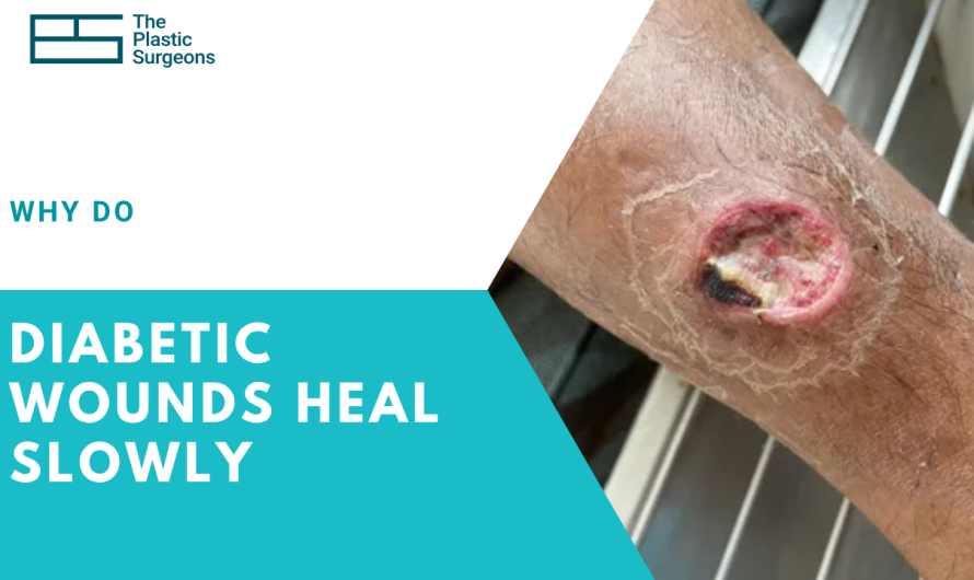 Why Do Diabetic Wounds Heal Slowly? Causes, Risk Factors & Treatment
