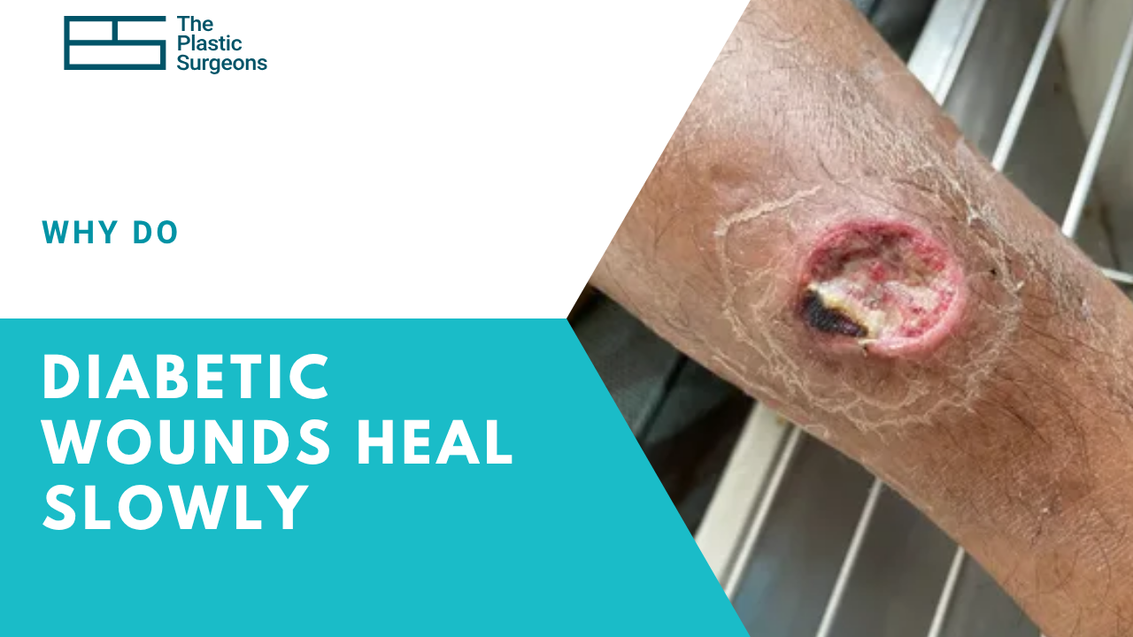 why-do-diabetic-heal-slowly