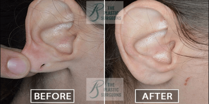 Best Ear Lobe Repair Surgery in Mumbai - Dr. Vinay Jacob