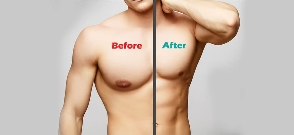 No Visible Scars - Best gynecomastia Surgeon in Mumbai