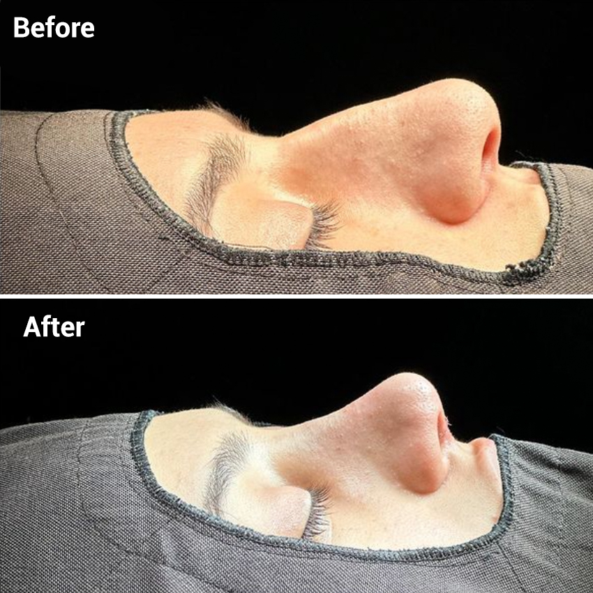 nose-Before-After