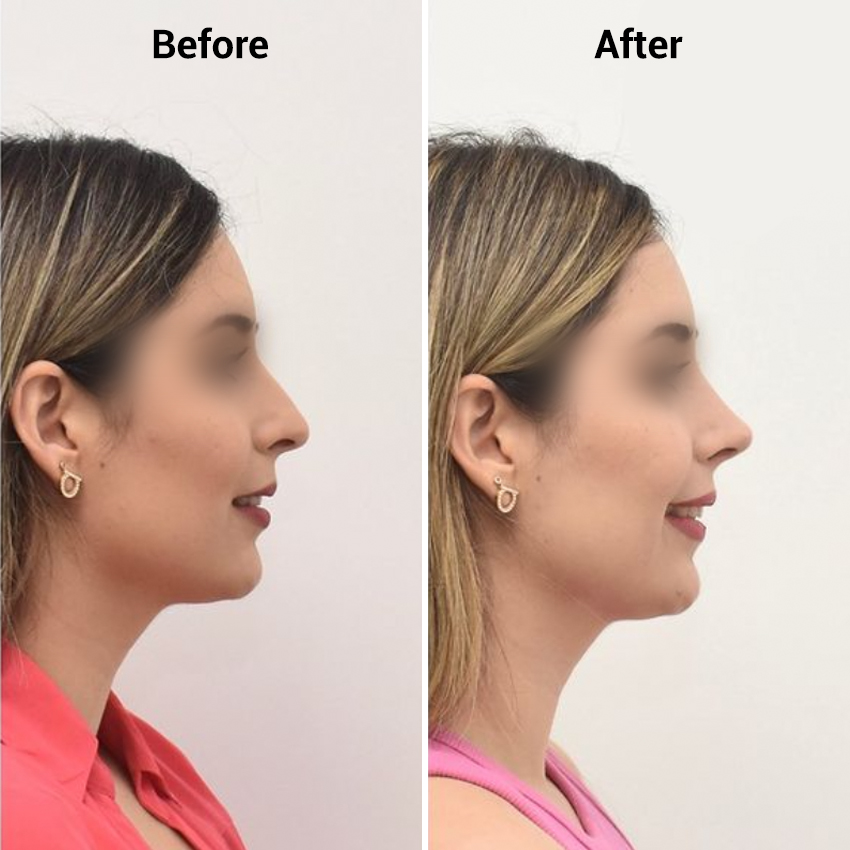 nose-Before-After