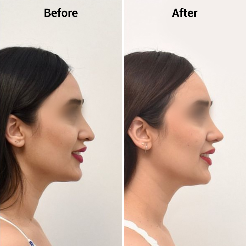 nose-Before-After