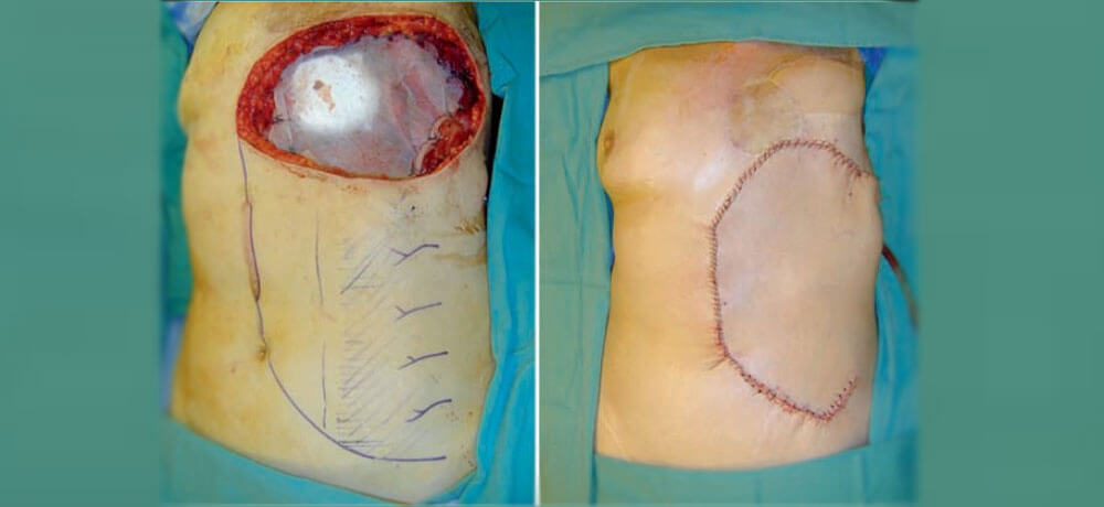 trunk-reconstruction